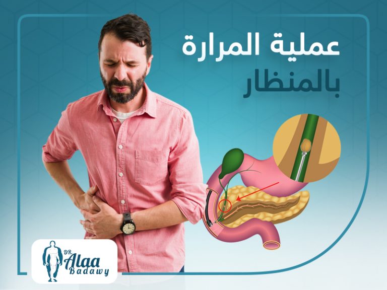 عملية المرارة بالمنظار