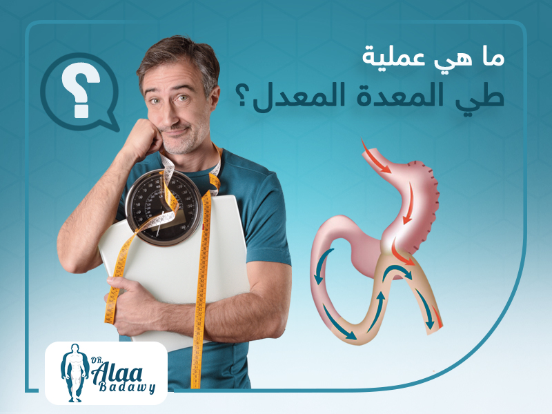 ما-هي-عملية-طي-المعدة-المعدل